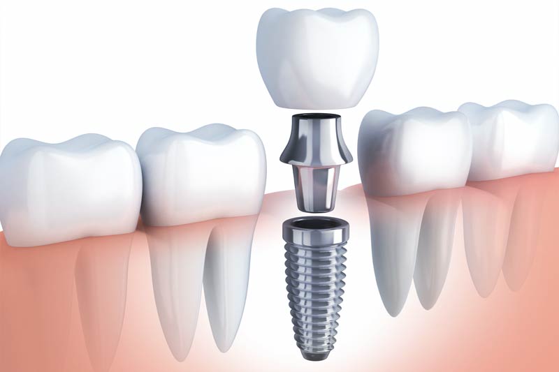 Implants Dentist in Surfside Beach