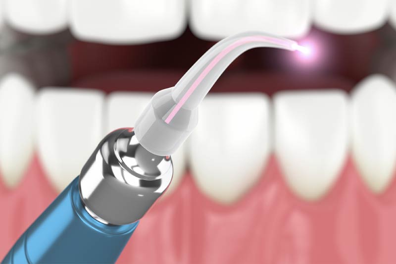 Laser Periodontal Therapy in Surfside Beach