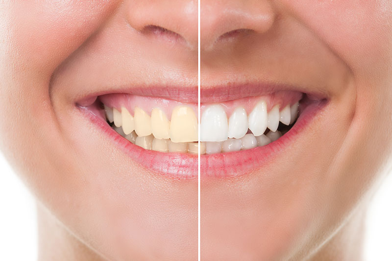 Teeth Whitening in Surfside Beach